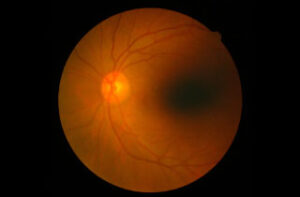 shkëputja dhe trajtimi i retinës